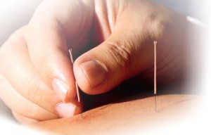 acupuncture needles acupuncture needles